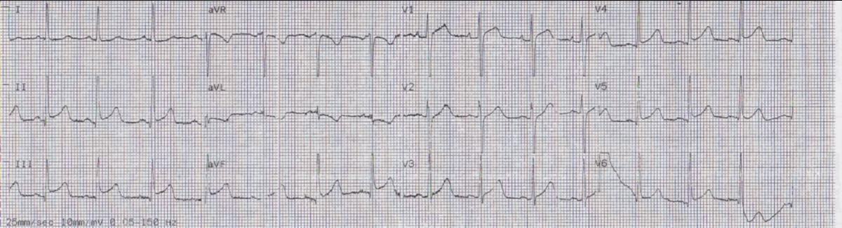 Bệnh nhân nữ 24 tuổi đau ngực: liệu STEMI? Viêm màng ngoài tim?