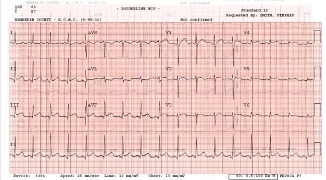 Bệnh nhân nữ 24 tuổi đau ngực: liệu STEMI? Viêm màng ngoài tim? Bệnh nhân nữ 24 tuổi đau ngực: liệu STEMI? Viêm màng ngoài tim?