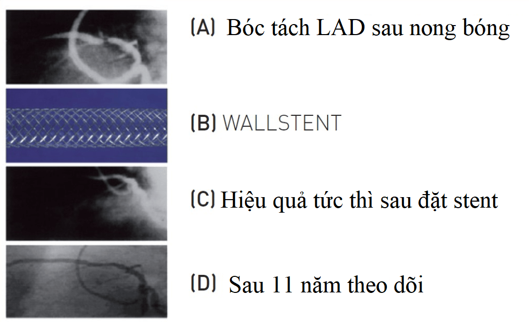 Đại cương về stent động mạch vành