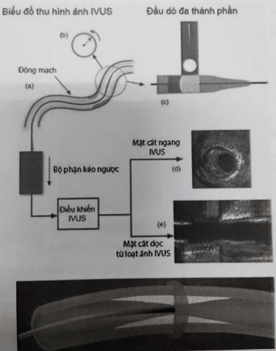Các bước thực hiện siêu âm trong lòng mạch vành Các bước thực hiện siêu âm trong lòng mạch vành