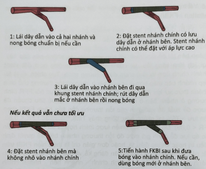 Kỹ thuật T stent là gì?