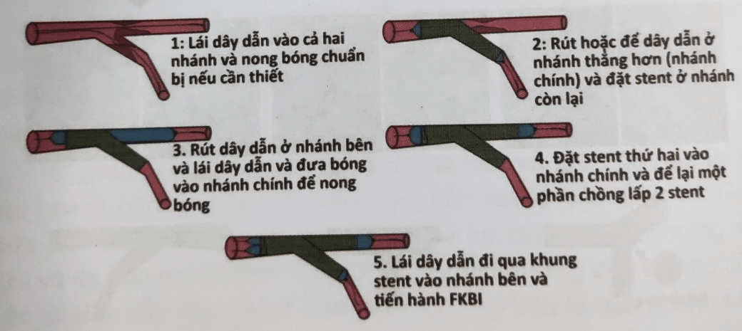 Kỹ thuật Culotte là gì?