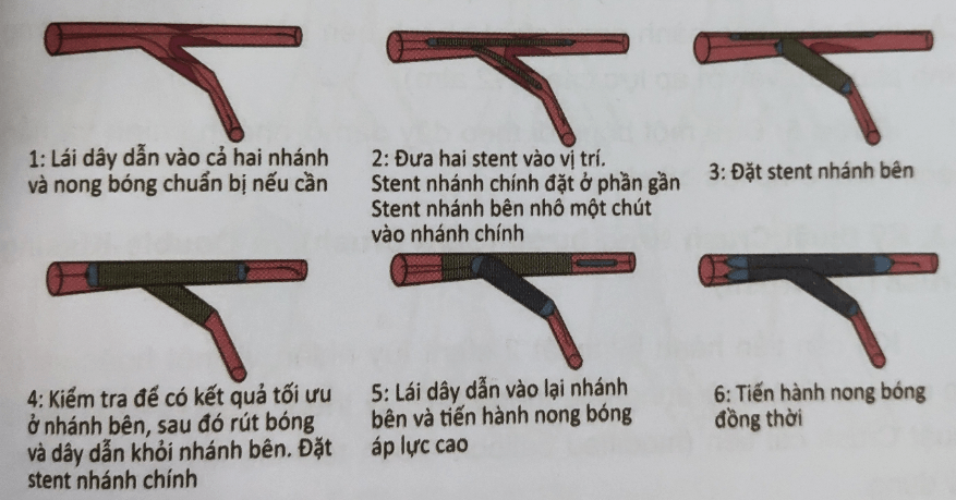 Kỹ thuật Mini Crush là gì?