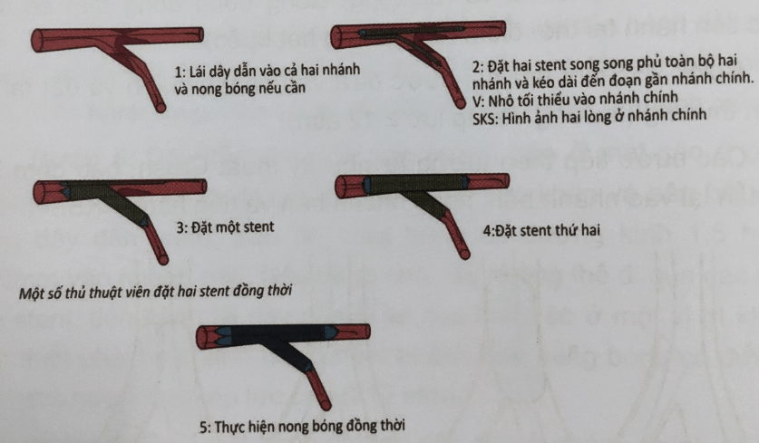 Kỹ thuật V stent và kỹ thuật SKS (Simultaneous Kissing Stent) là gì?