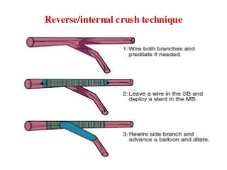 Kỹ thuật ReverseInternal Crush là gì