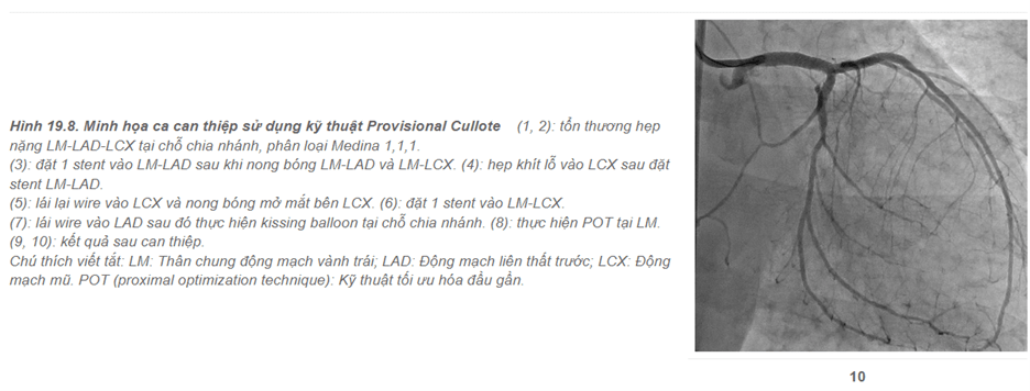 Kỹ thuật Provisional Culotte là gì