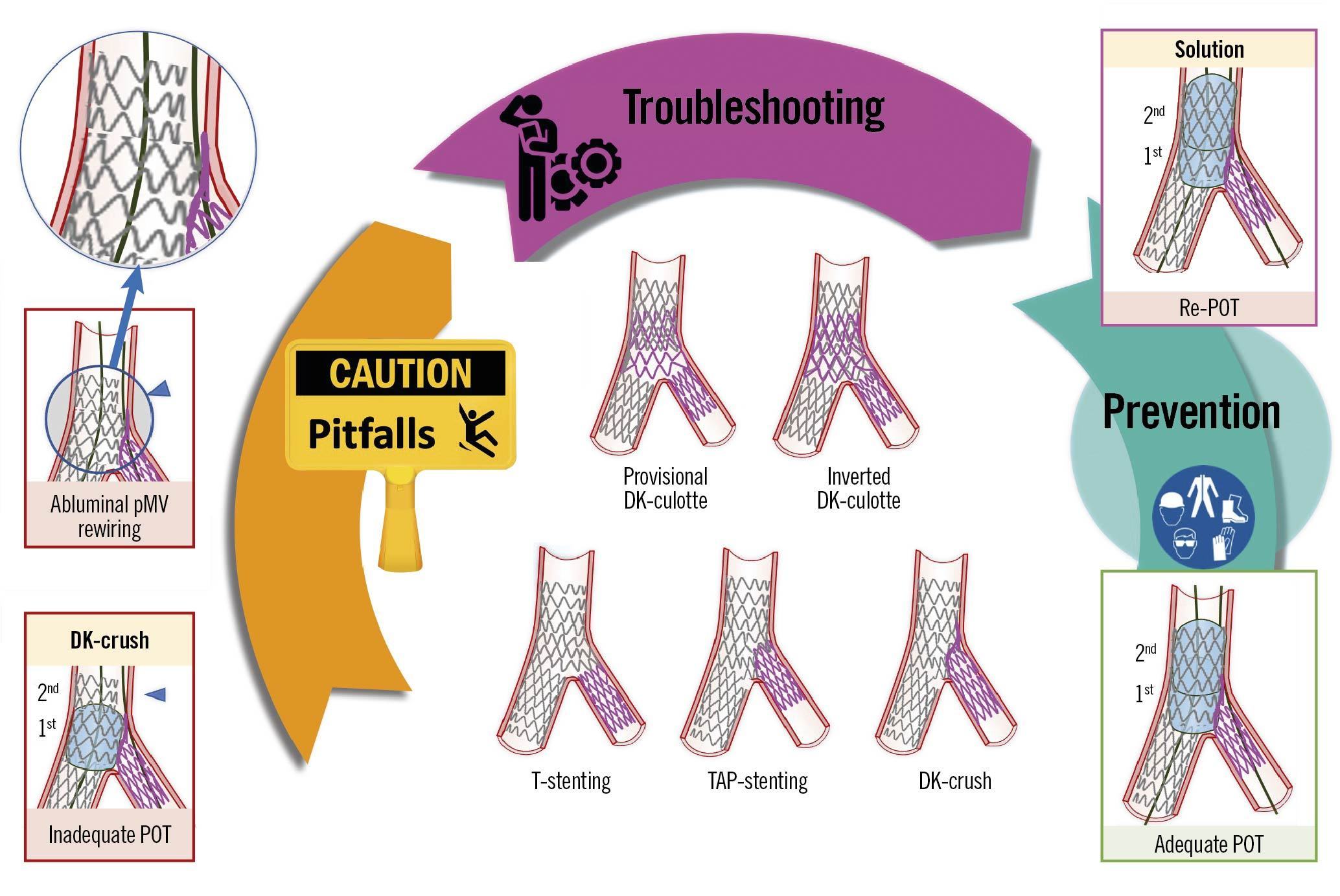 Kỹ thuật V stent và kỹ thuật SKS (Simultaneous Kissing Stent) là gì? Kỹ thuật V stent và kỹ thuật SKS (Simultaneous Kissing Stent) là gì?