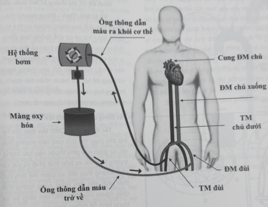 ECMO là gì? Chỉ định ECMO như thế nào? ECMO là gì? Chỉ định ECMO như thế nào?