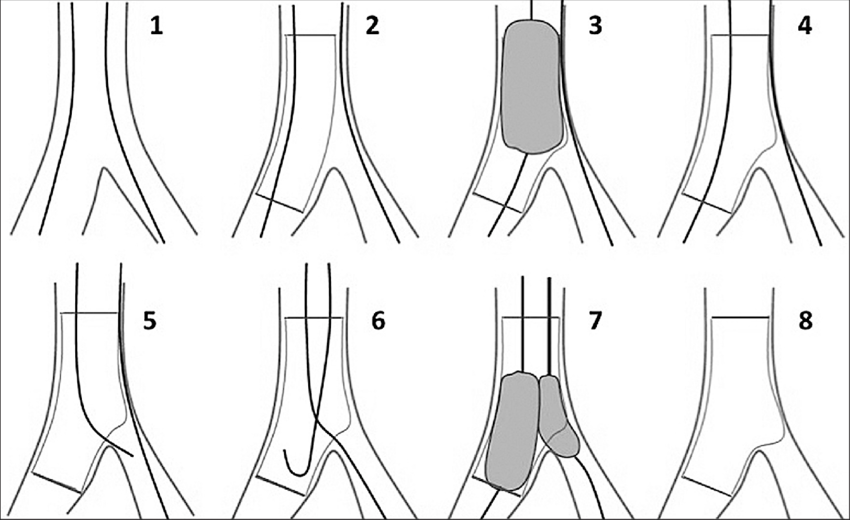 Kỹ thuật Provisional stenting Đặt 01 stent nhánh chính Kỹ thuật Provisional stenting Đặt 01 stent nhánh chính