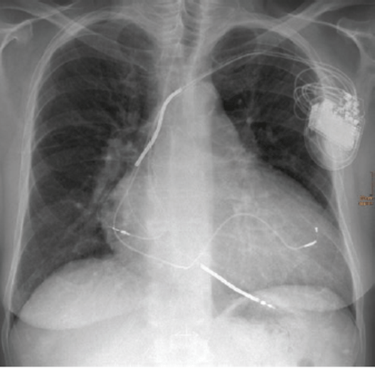 Phân tích CXR III