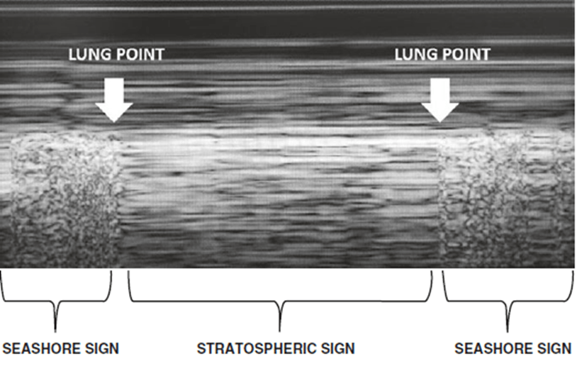 Phân tích siêu âm phổi Lung Ultrasound