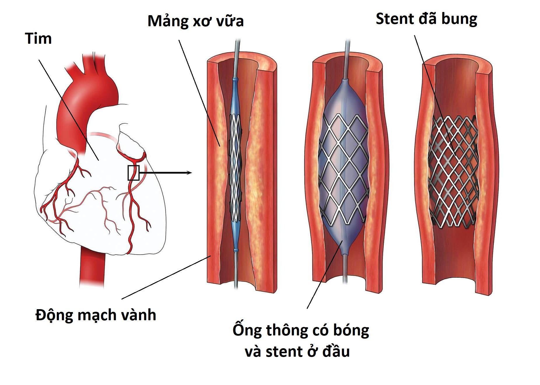Case số 01 ( 076 PCI 8195) Case số 01 ( 076 PCI 8195)