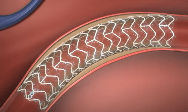 Stent XIENCE SIERRA