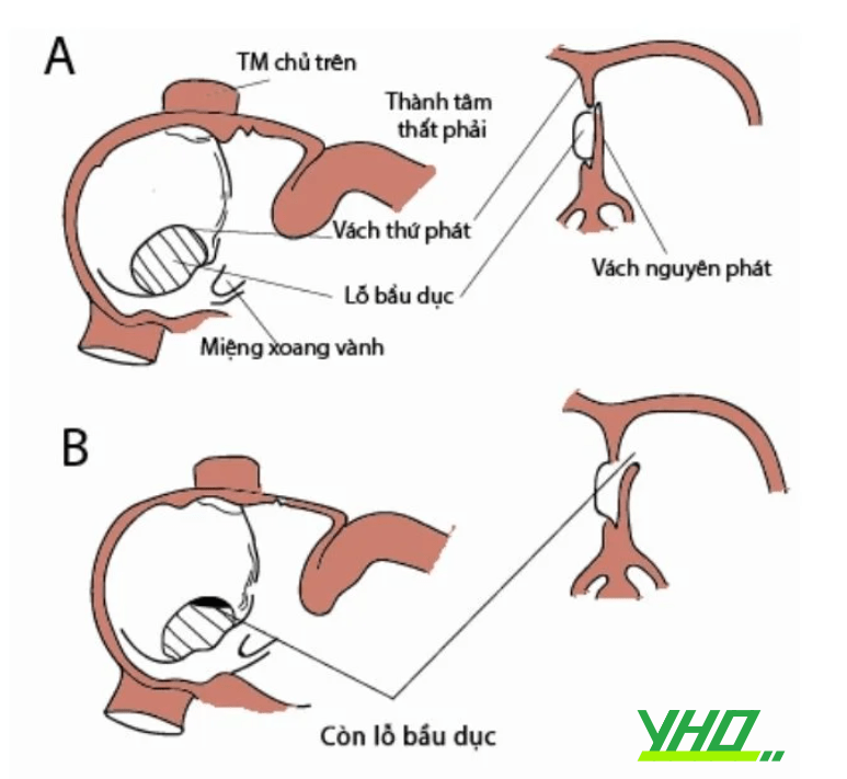 Thông liên nhĩ trong thực hành lâm sàng tim bẩm sinh. Thông liên nhĩ trong thực hành lâm sàng tim bẩm sinh.
