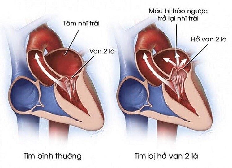 Hở van 2 lá