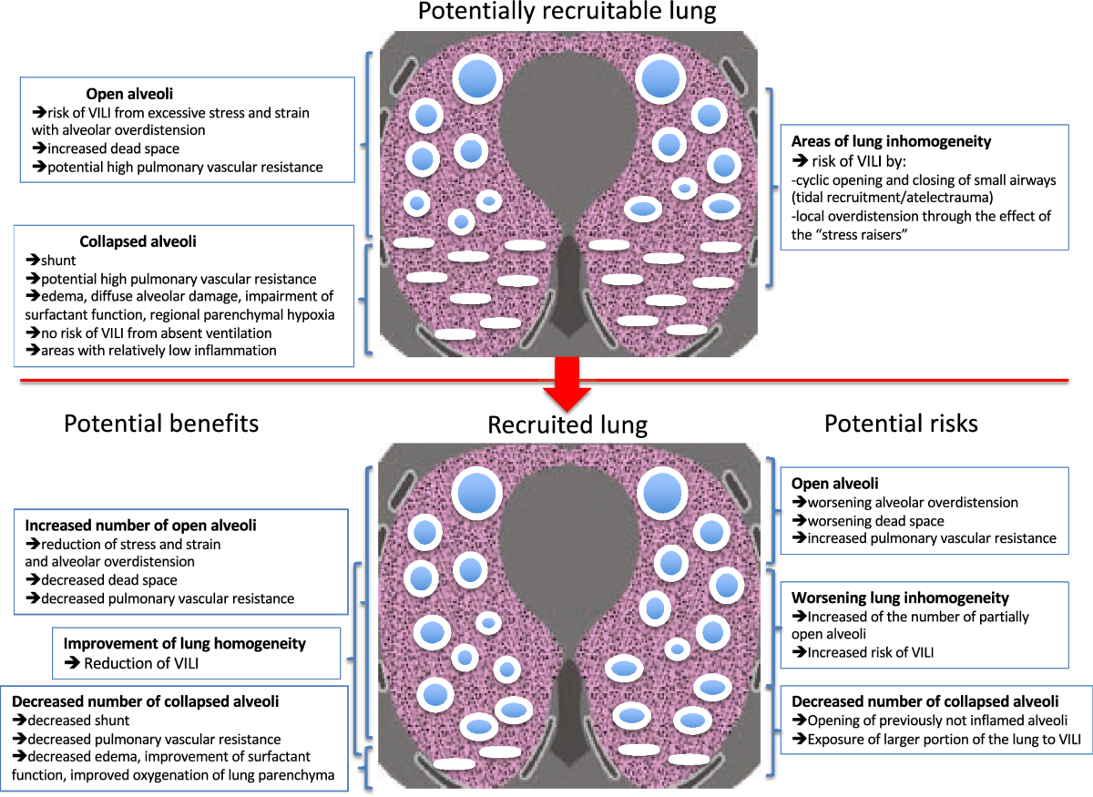 Sơ đồ minh họa chiến lược Open Lung Approach trong điều trị ARDS