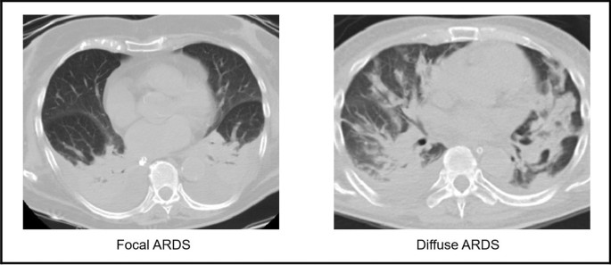 Hình ảnh CT scan ngực của bệnh nhân ARDS cho thấy đông đặc phổi mờ kính và dày thành phế quản