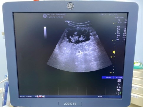 Đo thể tích tồn dư dạ dày GRV để đánh giá khả năng làm rỗng dạ dày