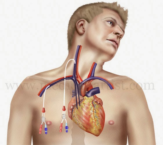 Điều dưỡng viên thực hiện thay băng gạc catheter tĩnh mạch trung tâm tuân thủ nghiêm ngặt các bước của quy trình vô khuẩn