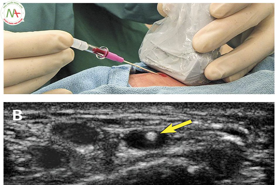 Hình ảnh minh họa kỹ thuật đặt catheter động mạch quay dưới hướng dẫn siêu âm