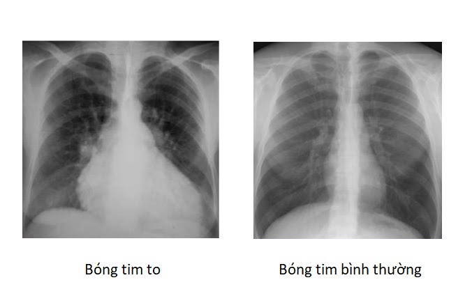 Hình ảnh Xquang tim phổi của bệnh nhân suy tim cấp cho thấy bóng tim lớn và ứ huyết phổi