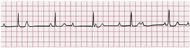 Điện tâm đồ minh họa block nhĩ thất độ 3 với sự phân ly hoàn toàn giữa nhịp P và nhịp QRS