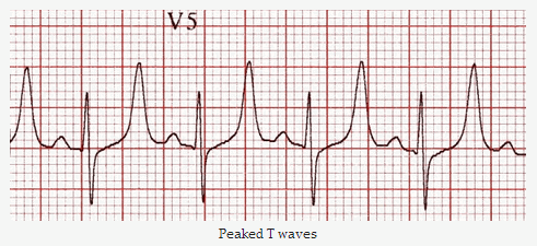Điện tâm đồ ECG minh họa các thay đổi điển hình trong tăng kali máu bao gồm sóng T nhọn cao và phức bộ QRS giãn rộng