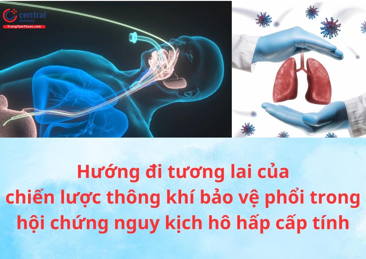 Sơ đồ minh họa chiến lược thông khí bảo vệ phổi trong ARDS bao gồm sử dụng thể tích khí lưu thông thấp áp lực đường thở đỉnh thấp và PEEP phù hợp