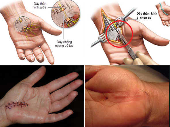 Hình ảnh minh họa phẫu thuật mở giải phóng ống cổ tay