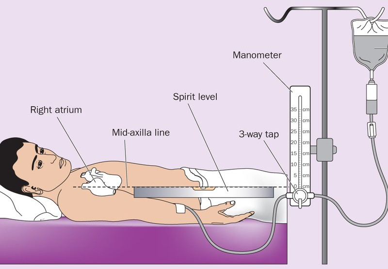 Hình ảnh minh họa cách đo áp lực tĩnh mạch trung tâm CVP bằng hệ thống đo áp lực và transducer