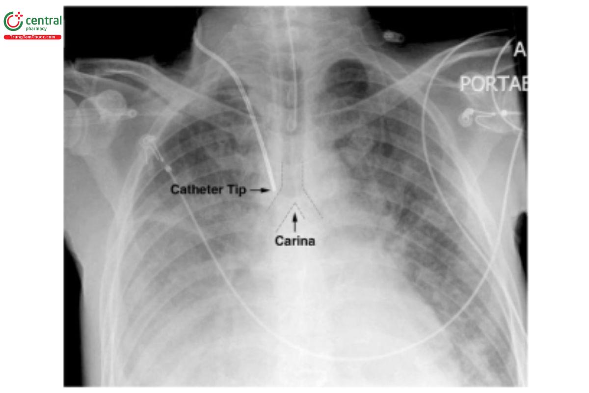 Hình ảnh Xquang cho thấy vị trí của catheter tĩnh mạch trung tâm sau khi đặt giúp xác định vị trí chính xác và loại trừ các biến chứng tiềm ẩn