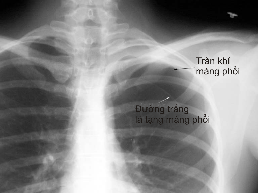 Hình ảnh siêu âm phổi cho thấy dấu hiệu tràn khí màng phổi