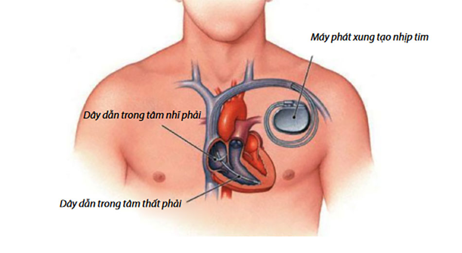 Điều dưỡng viên thực hiện tạo nhịp ngoài da cho bệnh nhân trong tình huống cấp cứu nhịp chậm