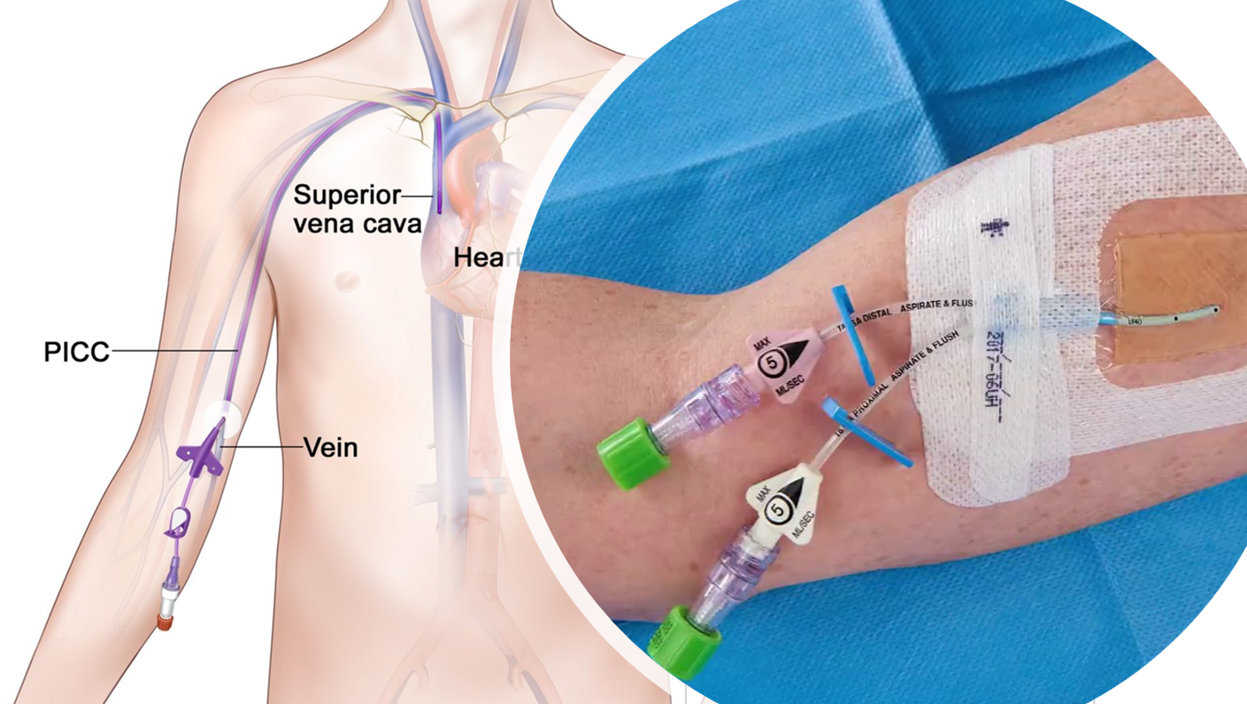 Điều dưỡng viên thực hiện thao tác bơm rửa catheter tĩnh mạch trung tâm bằng bơm tiêm
