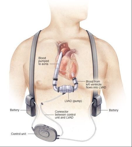 Hình ảnh minh họa thiết bị hỗ trợ thất trái LVAD được cấy ghép vào cơ thể bệnh nhân