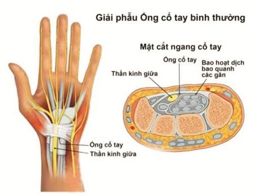 TÁCH BÓ THẦN KINH GIỮA (MEDIAN NERVE) ĐIỀU TRỊ HỘI CHỨNG ỐNG CỔ TAY DƯỚI HƯỚNG DẪN SIÊU ÂM