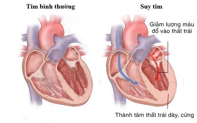 Các nguyên nhân phổ biến gây suy tim cấp Bệnh mạch vành Bệnh van tim Bệnh cơ tim Rối loạn nhịp tim Tăng huyết áp kịch phát Viêm cơ tim