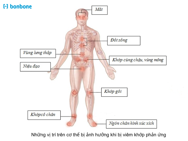 Hình ảnh minh họa phản ứng viêm toàn thân một cơ chế quan trọng trong các nguyên nhân gián tiếp gây ARDS