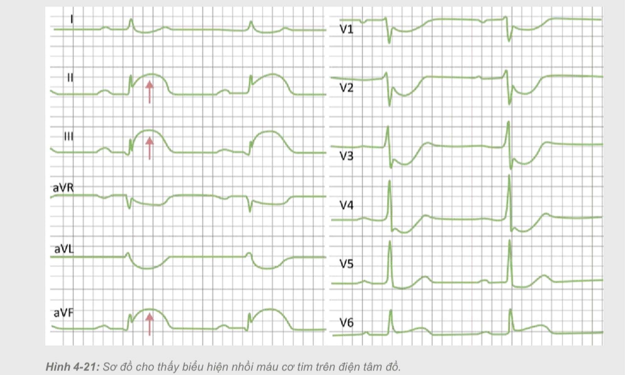 Nhồi máu cơ tim cấp – STEMI, NSTEMI