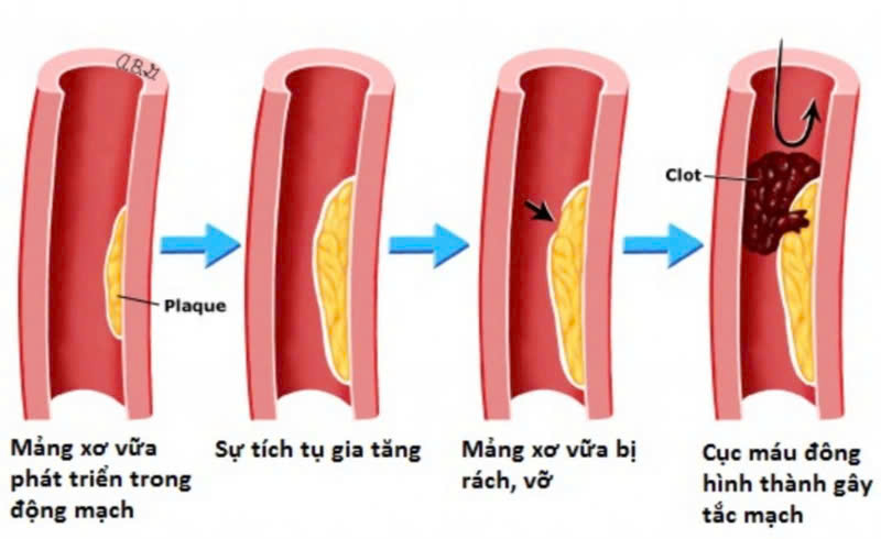 Hình ảnh minh họa mảng xơ vữa trong động mạch vành nguyên nhân chính gây nhồi máu cơ tim