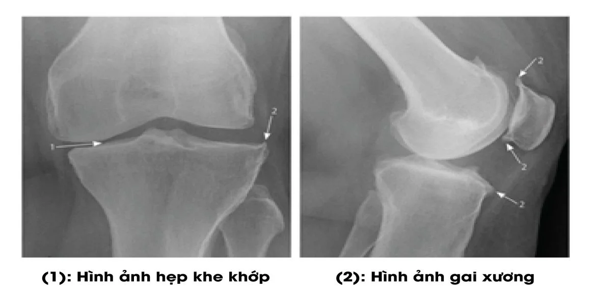 Hình ảnh Xquang cho thấy thoái hóa khớp gối