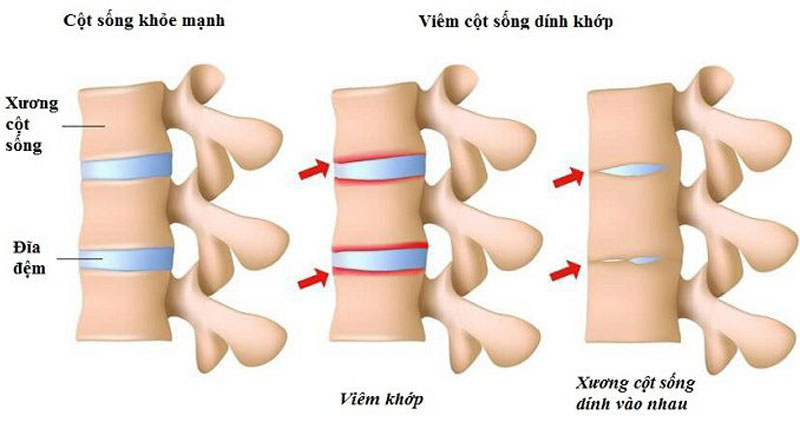 Mối liên hệ giữa gen HLAB27 và viêm cột sống dính khớp