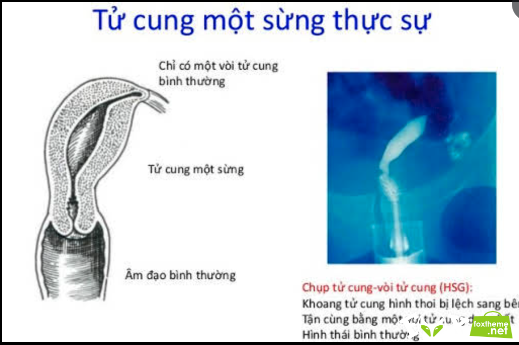 Hình ảnh siêu âm minh họa tử cung một sừng