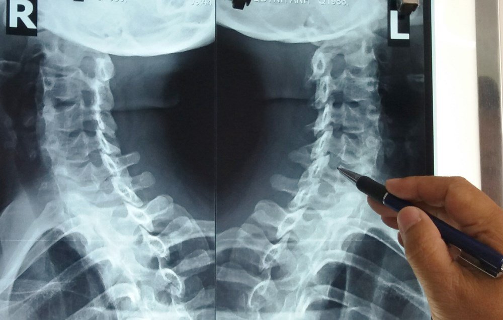 Tiêm vào cột sống thắt lưng dưới hướng dẫn của Xquang