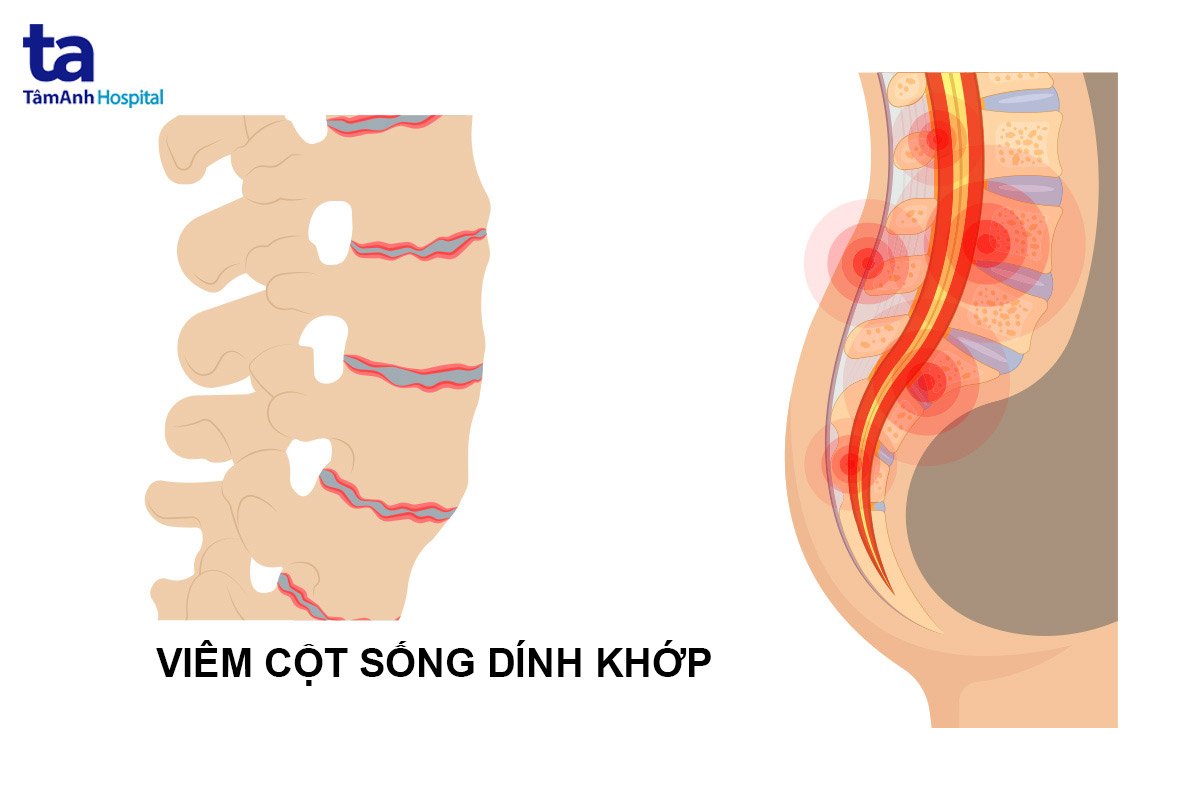 Viêm cột sống dính khớp trẻ em: Hướng dẫn chẩn đoán điều trị toàn diện
