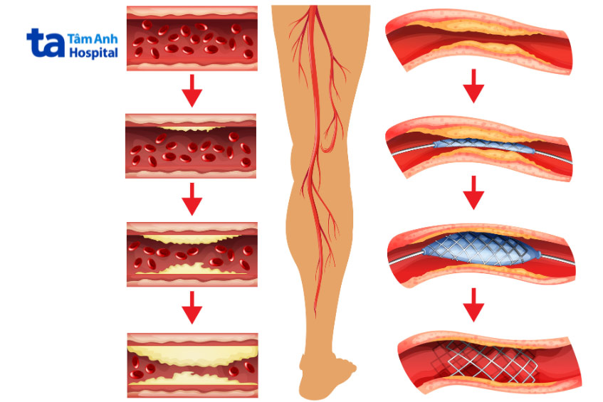 Hình ảnh minh họa nong mạch và đặt stent động mạch chi dưới