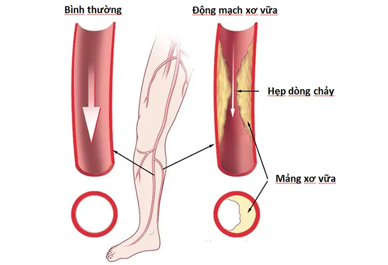 Bài tập đi bộ giúp cải thiện tuần hoàn máu cho bệnh nhân PAD