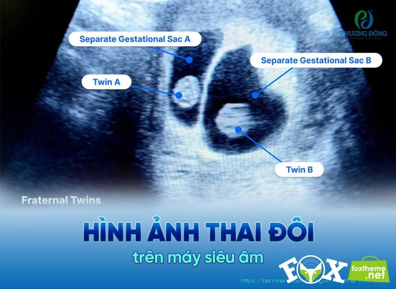Hình ảnh siêu âm song thai