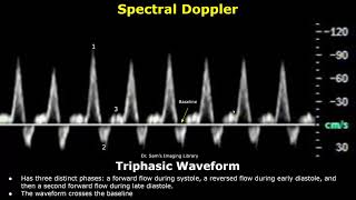 Dạng sóng Doppler ba pha bình thường