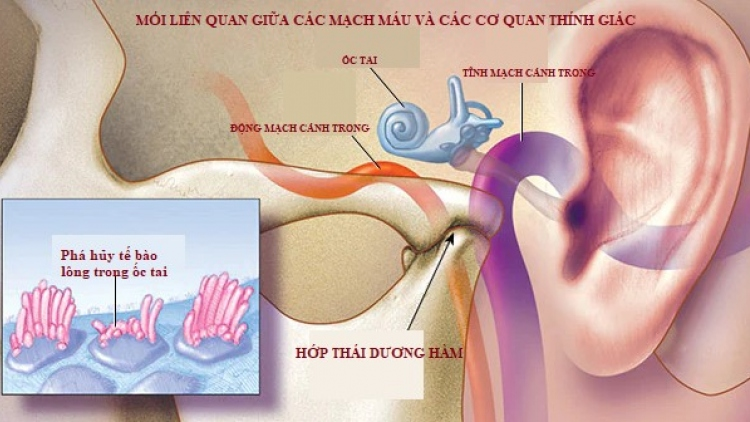 TIÊM TÁCH MÔ DƯỚI HƯỚNG DẪN SIÊU ÂM – DÂY THẦN KINH TAI LỚN TRONG Ù TAI